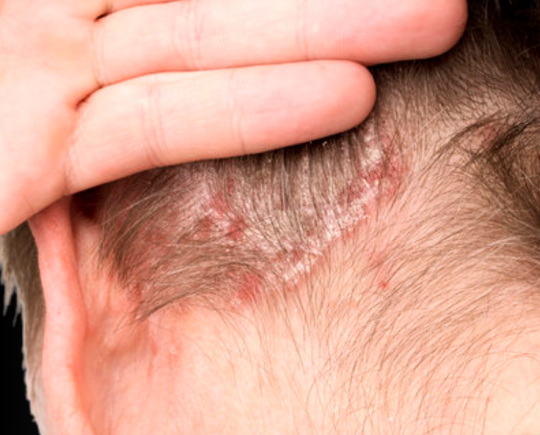 Dandruff and seborrheic dermatitis treatment in Guntur