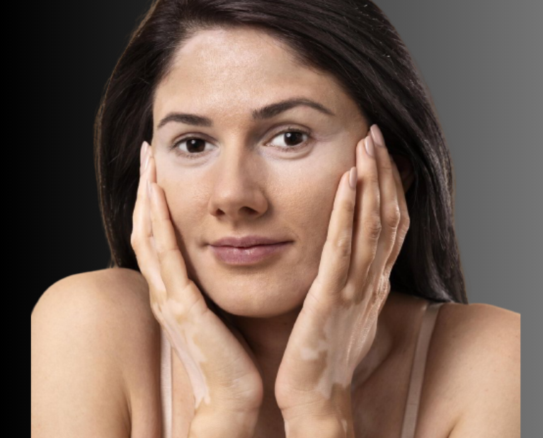 Vitiligo treatment in Guntur - advanced skin clinic