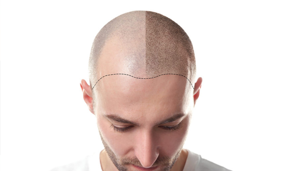 Scalp Micropigmentation treatment in Guntur