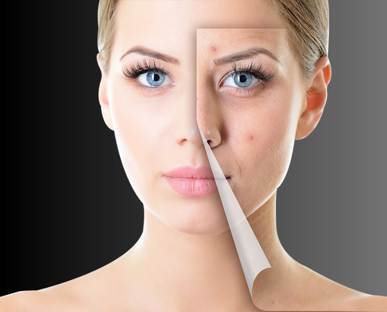 Best acne treatment in Guntur - Leelavathi Skin Centre