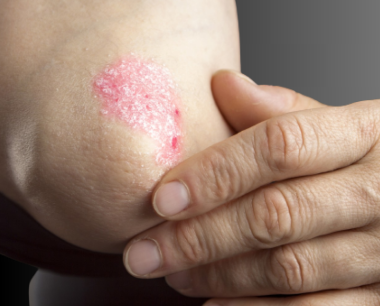 Psoriasis treatment in Guntur - Dr. Kavya Chennamsetty