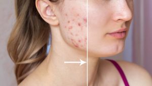 Best Acne Treatment in Guntur