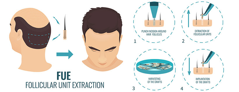 Bio Fue Hair Transplant