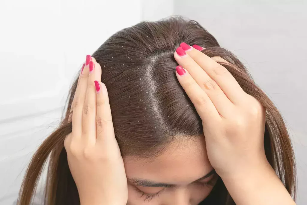 Best Dandruff Treatment in Guntur