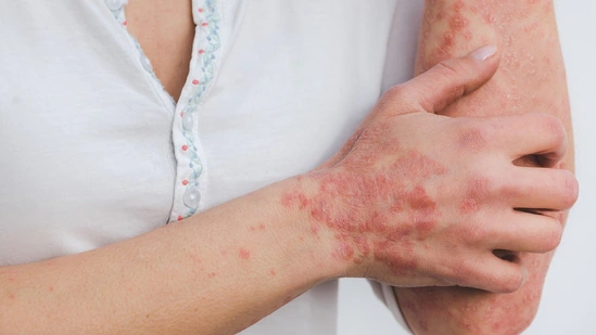 Psoriasis Treatment in Guntur