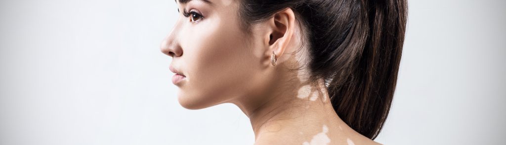 Best Vitiligo Treatment in Guntur